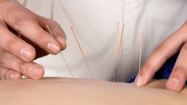 Acupuncture treatment at DiYi TCM