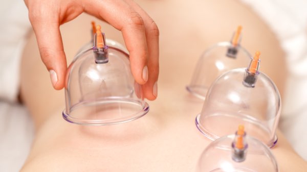 Cupping therapy at DiYi TCM